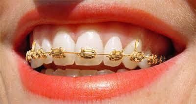 0.022/0.018 Slot Size DTC Orthodontic Dental Golden Coated Brackets Brace Ortho Fabric