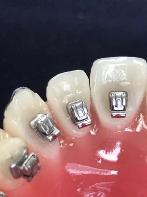 Clinic Molar Tubes Dental Lingual Brackets for DTC Orthodontics Self-Ligating Bracket