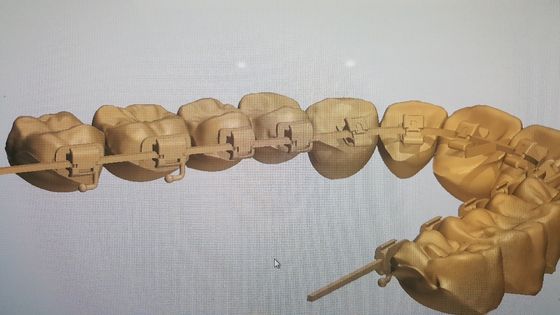 Powerful Machinery Source DTC Orthodontics Lingual Braces with Self-Ligating Brackets