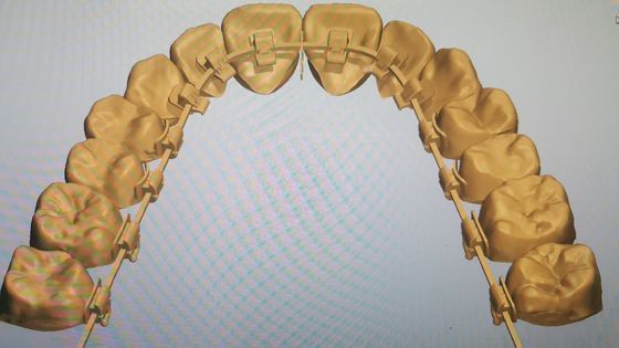 Powerful Machinery Source DTC Orthodontics Lingual Braces with Self-Ligating Brackets